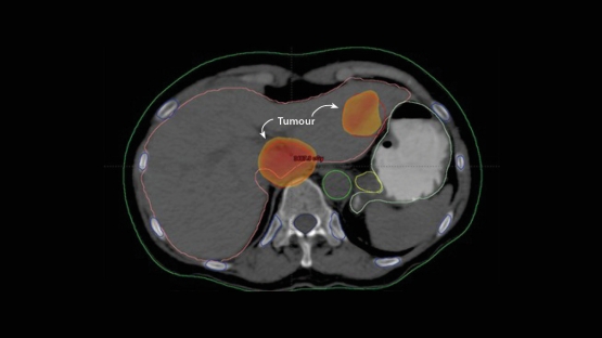 La radioterapia destruye más células cancerosas que nunca
